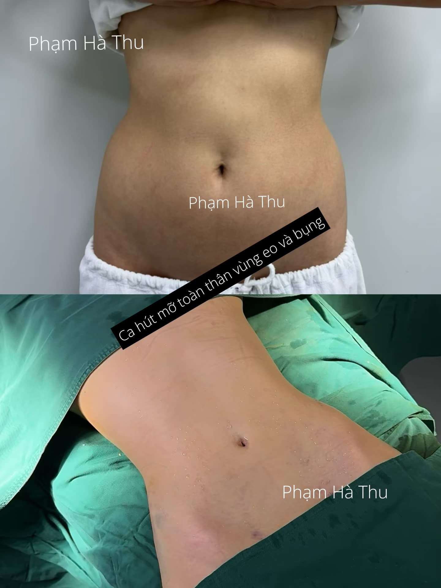 HÚT MỠ 1