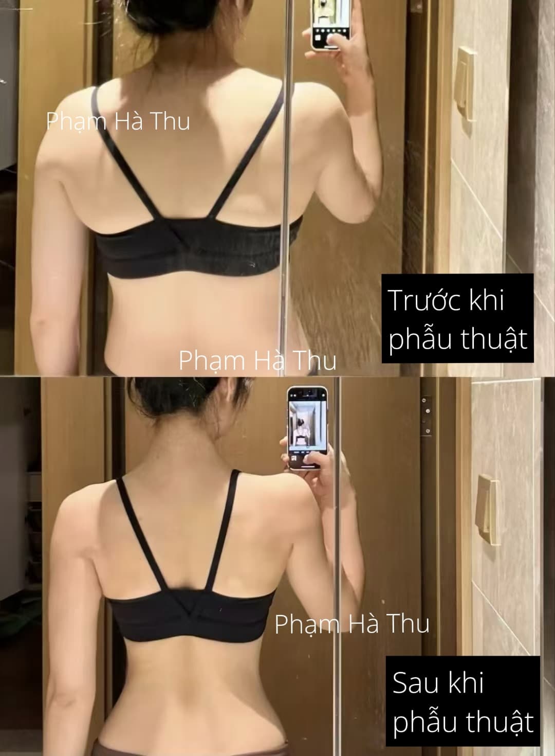 HÚT MỠ 2