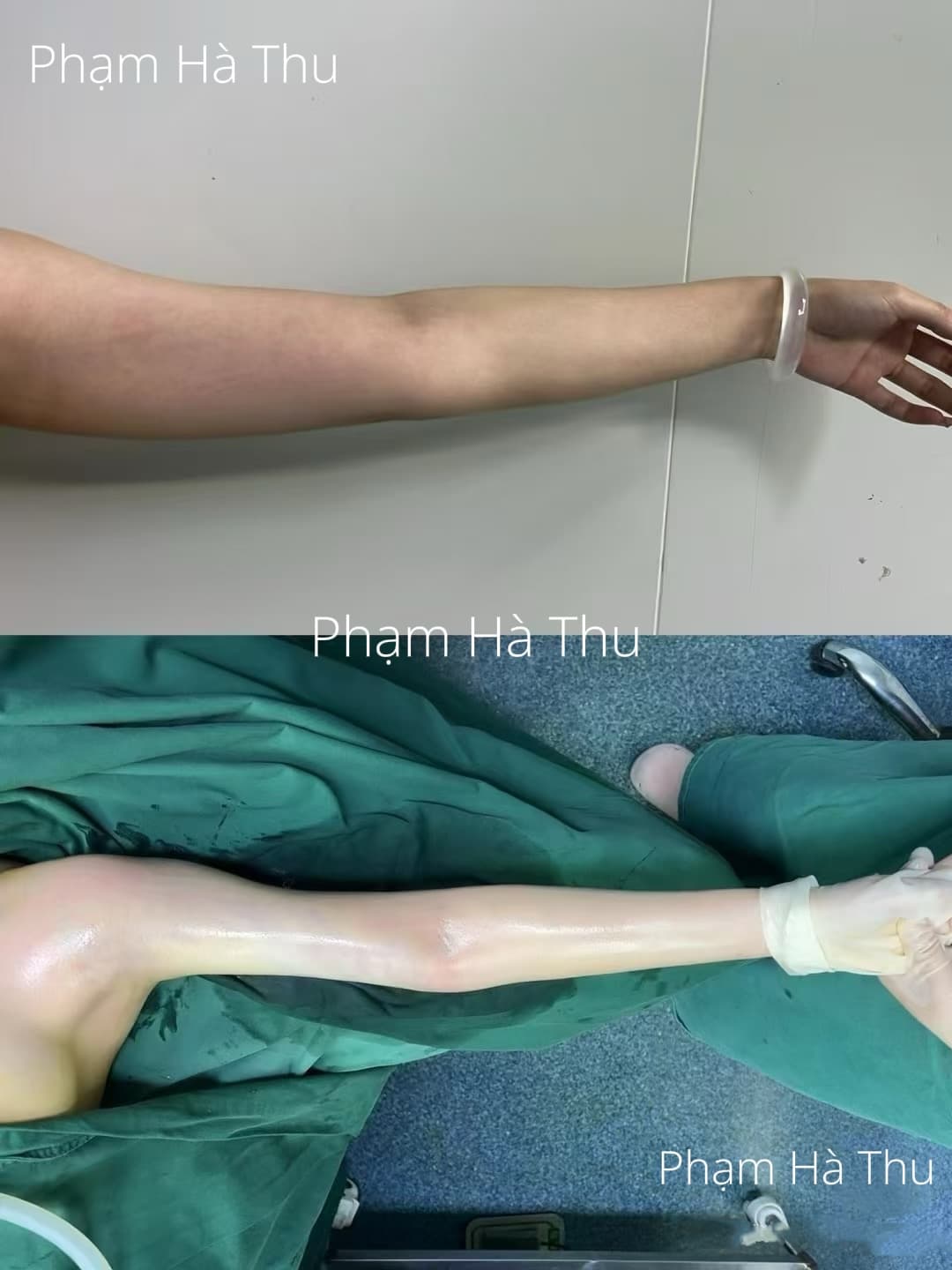 HÚT MỠ 4