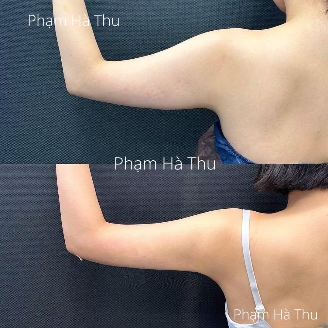 HÚT MỠ 5